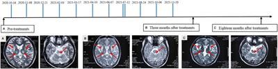 Case report: Treatment of Wilson’s disease by human amniotic fluid administration